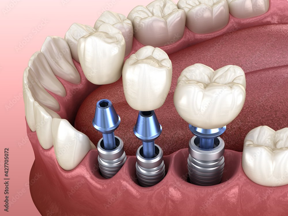 Ilustração magnífica mostrando implantes dentários