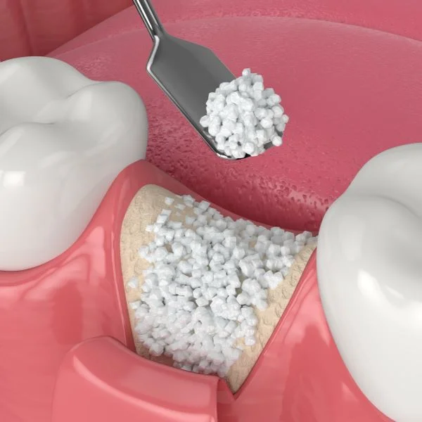 Ilustração perfeita do conceito de enxerto ósseo para implantes dentários