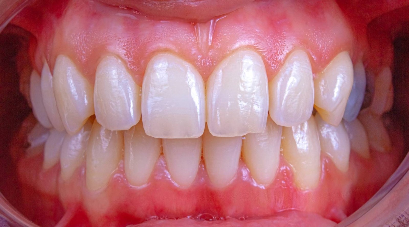 Cirurgia Plástica Periodontal, imagem de uma boca saudável após enxerto gengival