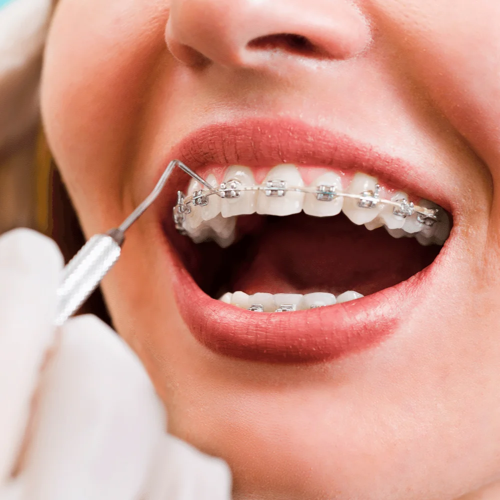 Imagem de ortodontista ajustando aparelho fixo de uma jovem com dentes quase 100% alinhados