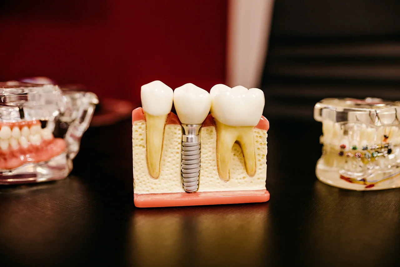 Implante Dentário, Guia Completo Antes da Cirurgia